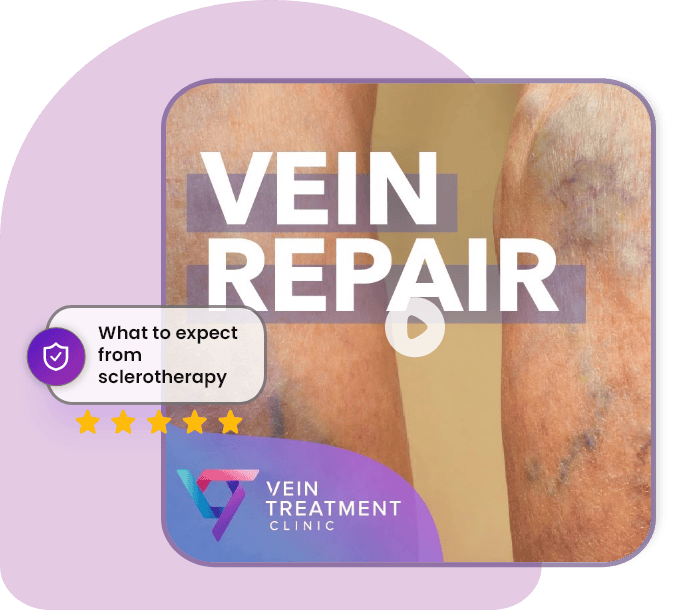 Foam Sclerotherapy VeinDoctor