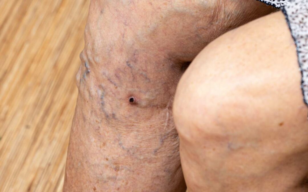 Varicose Veins: Don’t Wait Until is too Late!