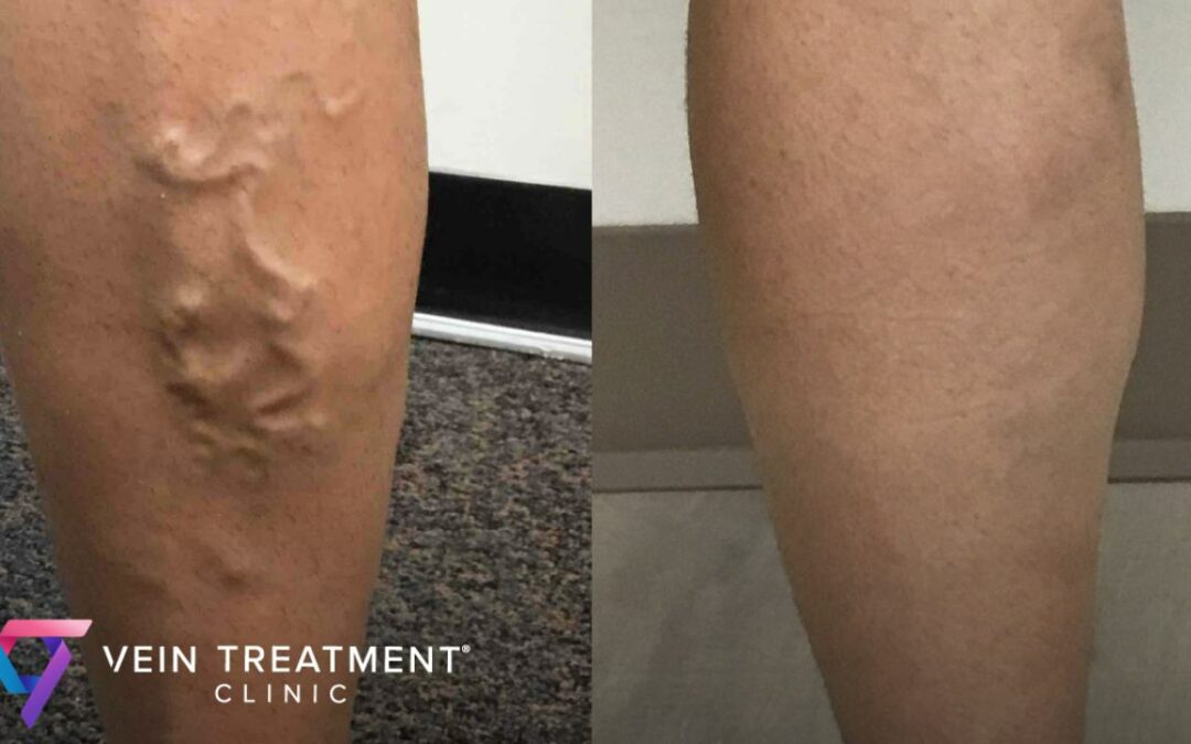 Spider Veins vs. Varicose Veins: A Guide from Vein Doctor