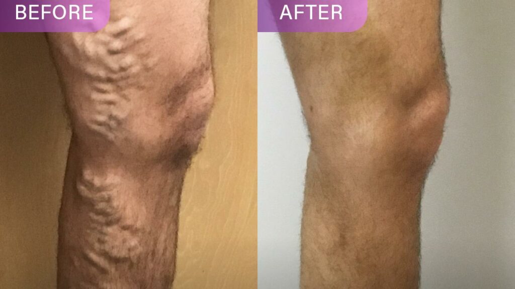 Vein treatment performed by vein doctors
