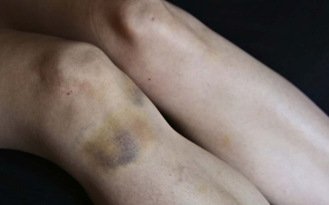 Can Varicose Veins Cause Bruising? What You Should Know