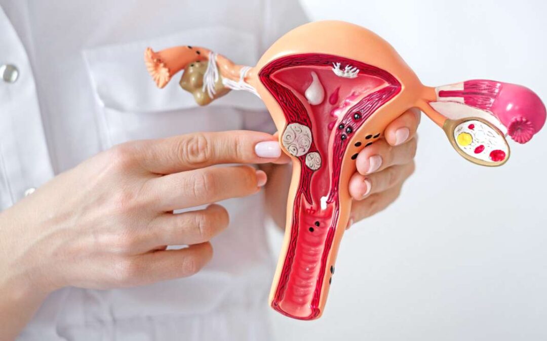 Foods to Avoid with Uterine Fibroids: Treat Fibroids Today!