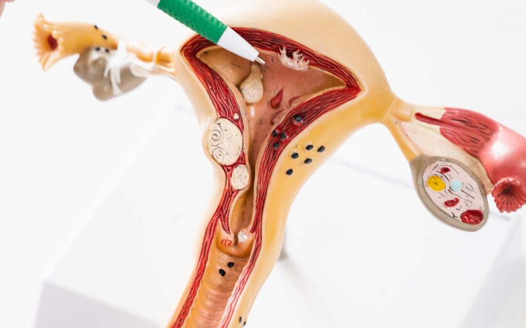 What Are the Side Effects of Uterine Fibroid Embolization?