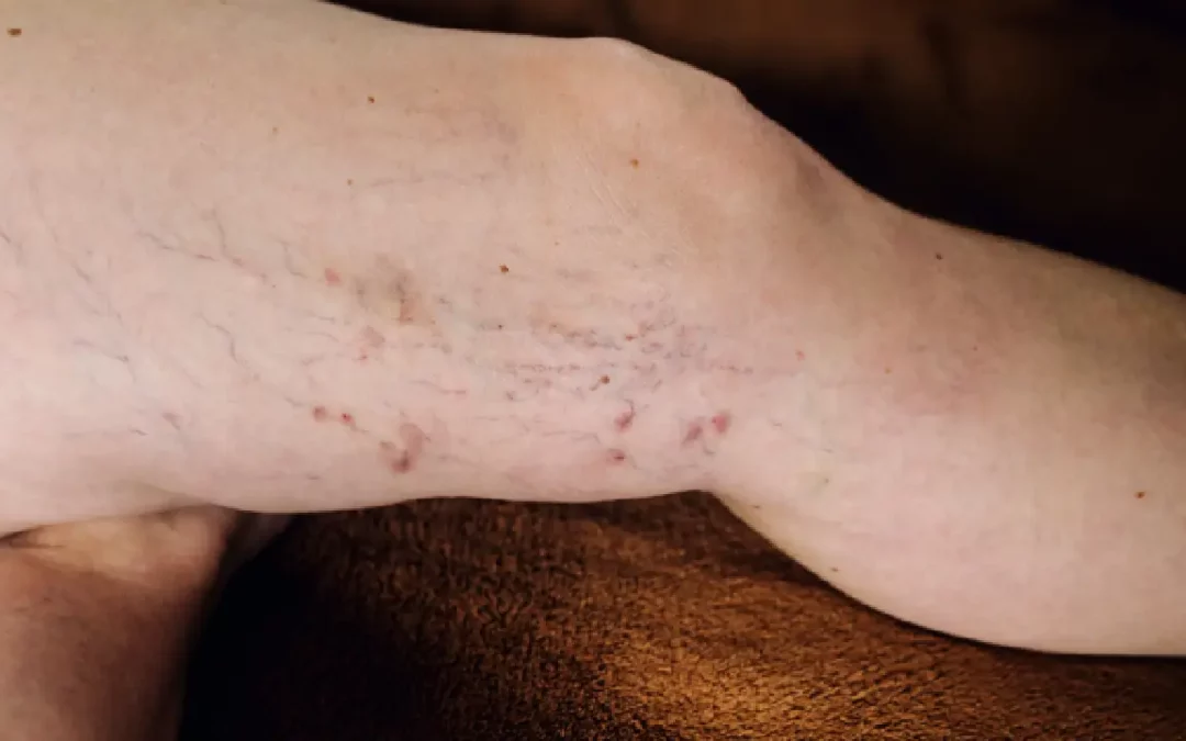 Treat Your Spider Veins at the New Vein Clinic in Harrison, NJ