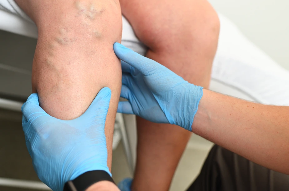 Dr. Tyson Can Provide the Best Treatment for Venous Insufficiency