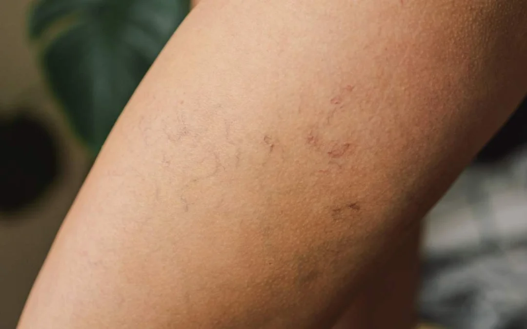 Find the Best Treatment for Spider Veins in Farmington, CT