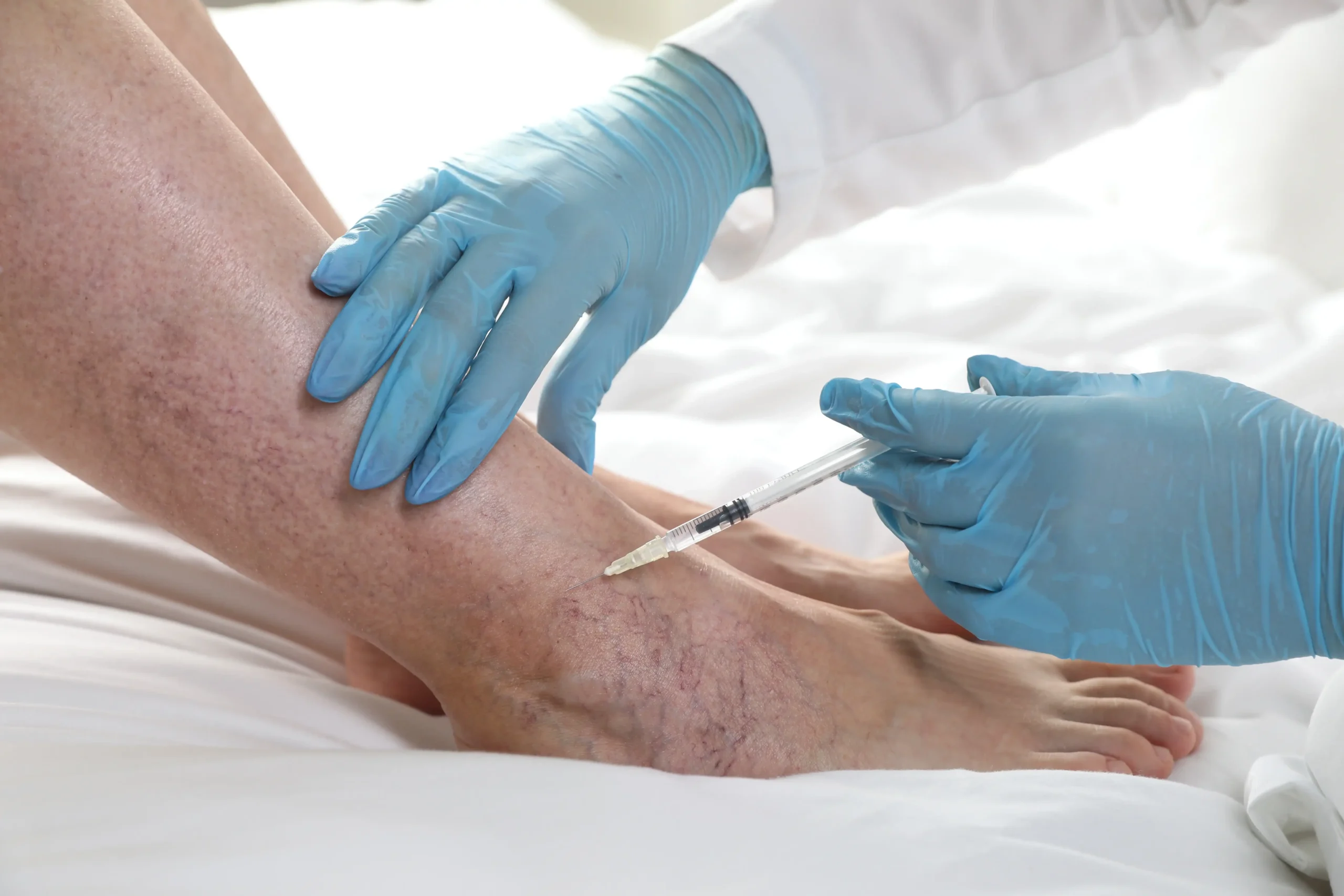 Sclerotherapy procedure for spider veins at Vein Treatment Clinic in Astoria.