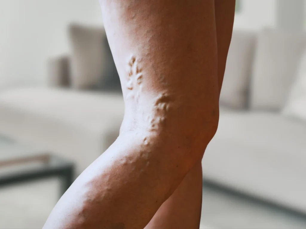 Who is the best vein doctor to treat chronic venous insufficiency in Astoria?