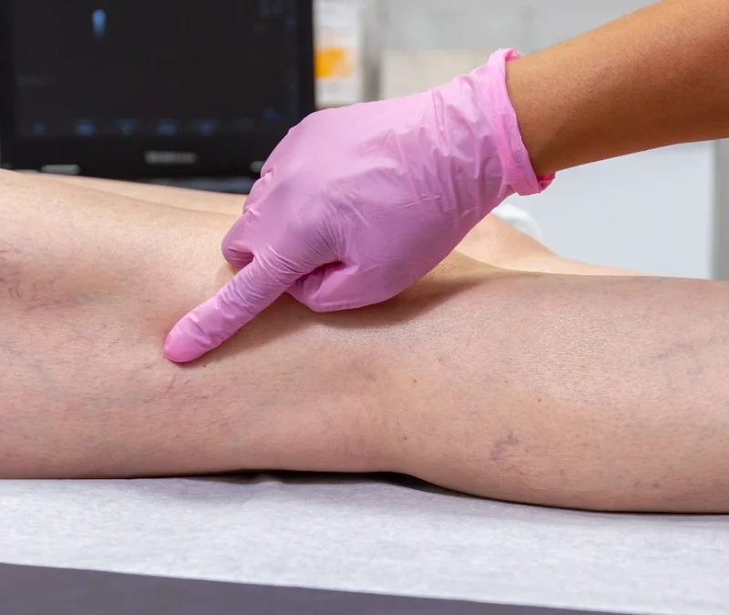 Find the Best Treatment for Spider Veins in West Hartford, CT